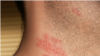 Bệnh zona (herpes-zoster, shingles)